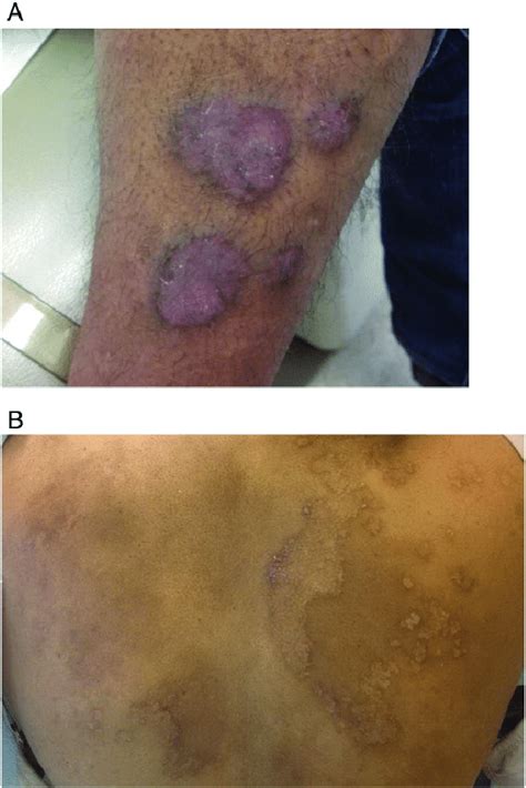 A 34-year-old Indian woman with chronic plaque psoriasis who begins to... | Download Scientific ...