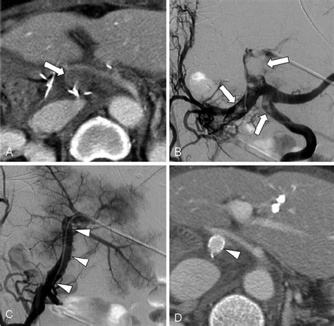 Patient 9 A B Axial CT A And Percutaneous Transhepatic Venogram