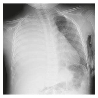 A Chest X Ray And B Chest Computed Tomography Scan Of The Thoracic