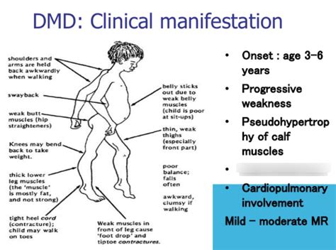 Pt 509 Unit 3 2 Duchenne Muscular Dystrophy Diagram Quizlet