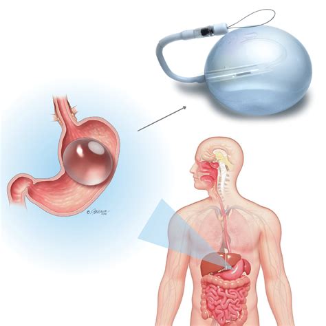 Bal O Intrag Strico Cronos Endoscopia