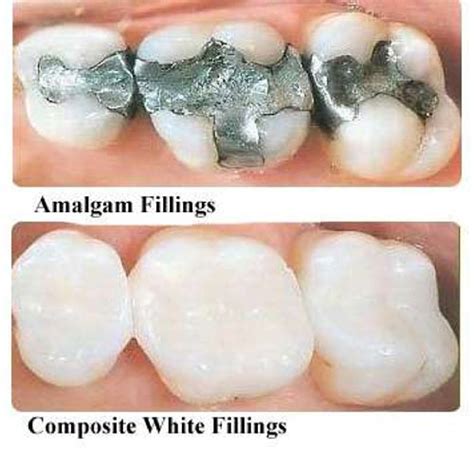 Dental Fillings Composite And Amalgam Mediatrix