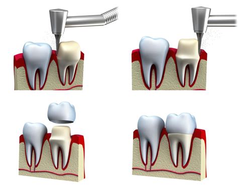 The Process Of Getting A Dental Crown 3d Dentistry Bradenton Fl