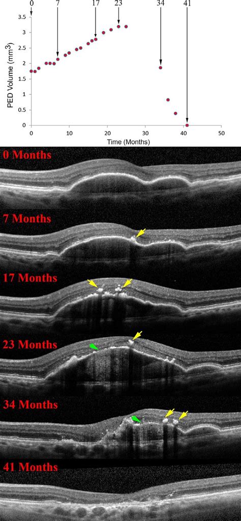 Retinal Pigment Epithelium Changes And Its Relationship To The