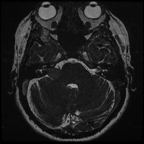 Right Vestibular Schwannoma in 62 year old woman | Dr Sean Flanagan