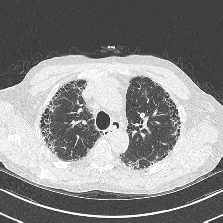 Pulmonary Fibrosis