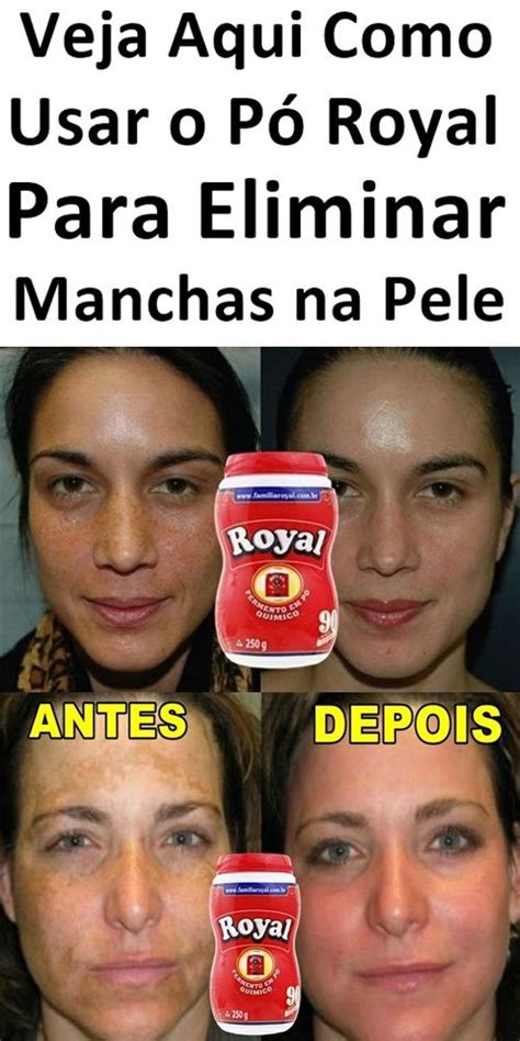 Receita P Royal Para Eliminar Manchas No Rosto Passo A Passo B