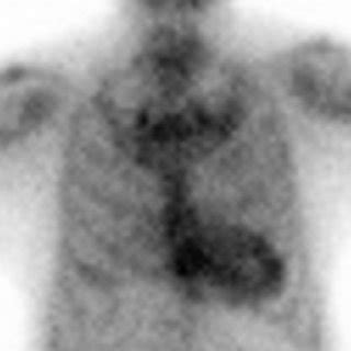 99m Technetium Pyrophosphate Cardiac Amyloid Imaging Scan Showing Grade