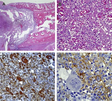 Nosology And Pathology Of Langerhans Cell Histiocytosis Oncohema Key