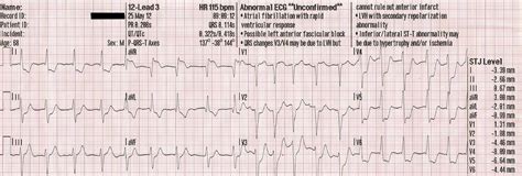 Left Main Coronary Artery Obstruction | ECG Guru - Instructor Resources