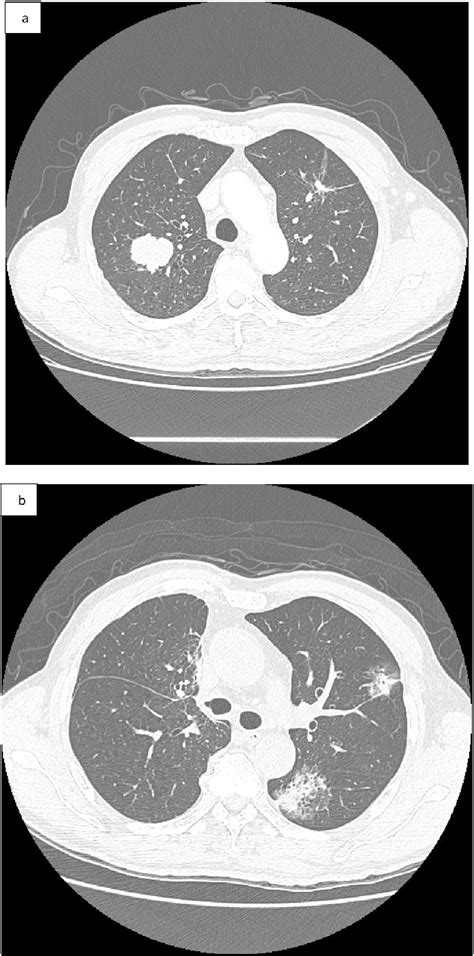 Figure 2 From A Rare Case Of Synchronous Multiple Primary Lung Cancer With Different Responses