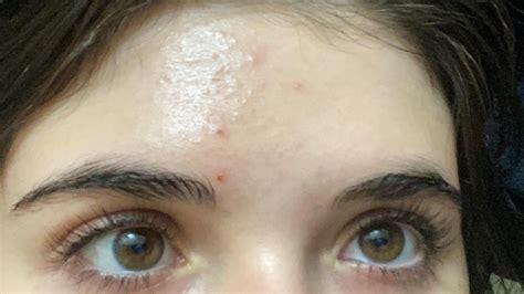 How To Get Rid Of This Forehead Texture Rskincareaddiction