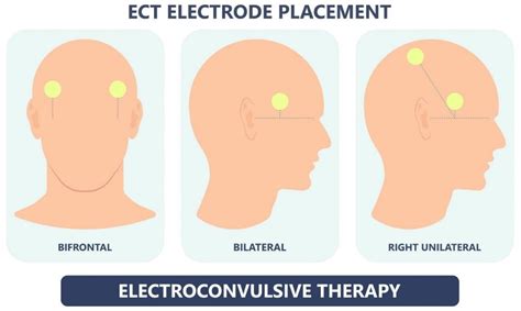 Electroconvulsive Therapy Ect Ncmd