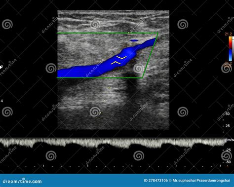 Color Doppler Ultrasound Determination In Deep Vein Thrombosis Patients