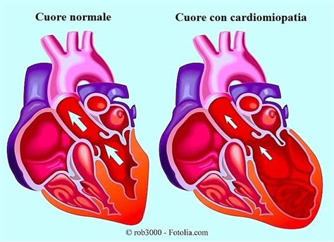 Cardiopatia Ischemica Acuta O Cronica Dilatativa Sintomi E Terapia