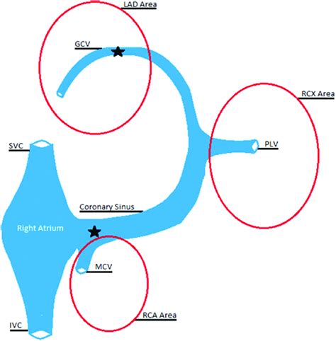 Schematic View Of The Coronary Venous System Lad Left Anterior