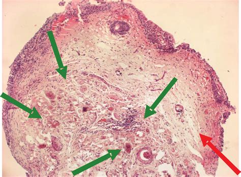 Schistosoma Haematobium Egg Morphology