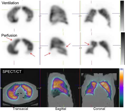 Vq Scanning Using Spect And Spectct Journal Of Nuclear Medicine