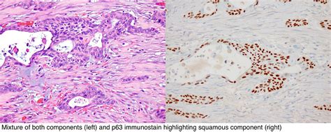 Pathology Outlines Adenosquamous Carcinoma