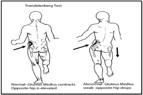 Abnormal Mobility Flashcards Quizlet