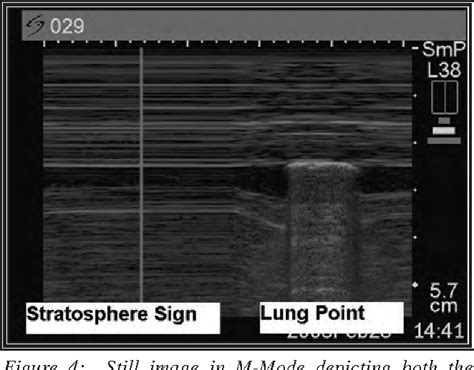 Figure From Ultrasound Detection Of Pneumothorax With Minimally