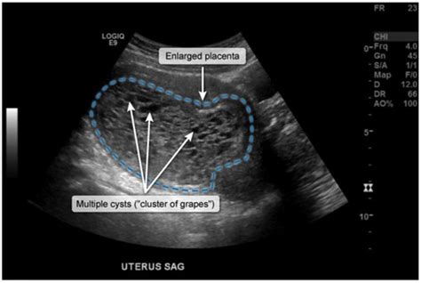 Uworld Ob Gyn Flashcards Quizlet