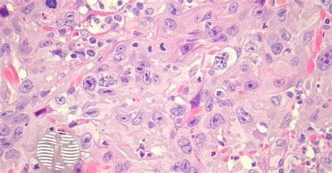 Dermnet® Poorly Differentiated Squamous Cell Carcinoma Pathology Image