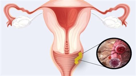 Vaginale Kanker Symptomen En Tekenen Tumorclassificatie Diagnose