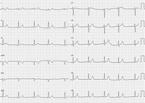 Spontaneous Wide Qrs Complex Rhythm In A Patient With Wide Qrs Complex Tachycardia Circulation