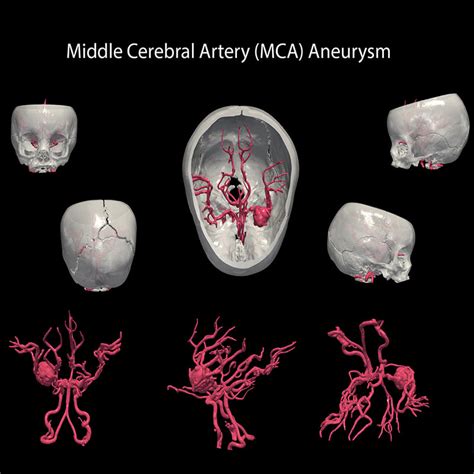 3d Model Of Middle Cerebral Artery Mca Aneurysm