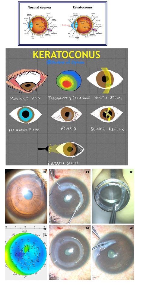 Rizzuti Sign Keratoconus