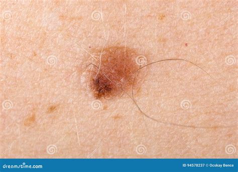 Nevus On Human Skin Stock Image Image Of Dermatology 94578237