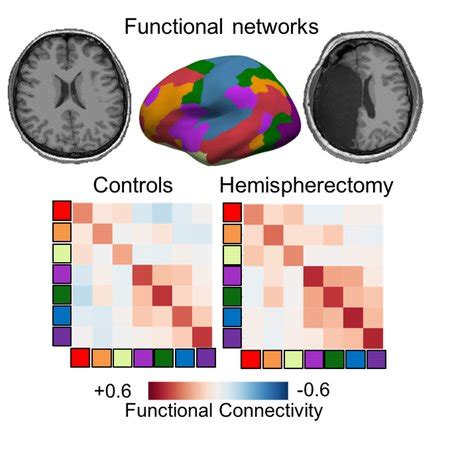 Patients Missing One Brain Hemisphere Show Surprisingly Intact Neural Connections - www.caltech.edu