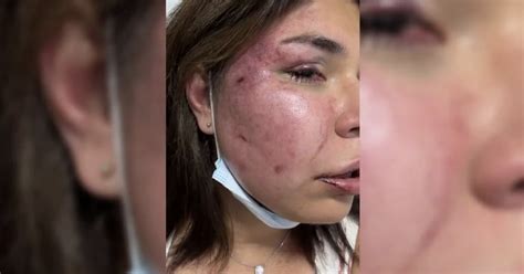 Alicia Bárcena Apoya A Mexicana Que Sufrió Un Intento De Feminicidio En