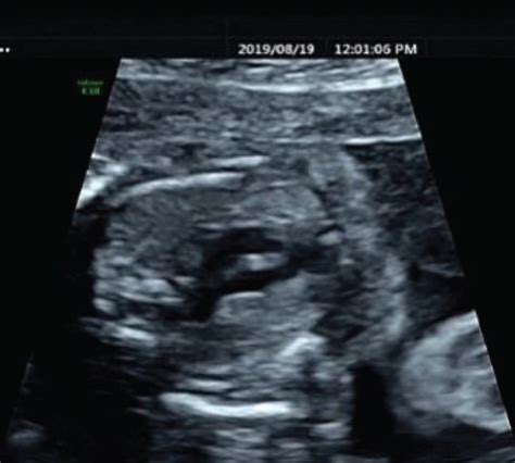 Ultrasonic Images Of Fetus With Abnormal Heart A Persistent Left