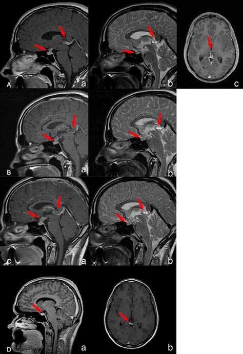 Central Diabetes Insipidus Caused By A Pituitary Stalk Germinoma