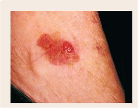 Pdf Non Melanoma Skin Cancer Skin Cancer Causes Risk Factors And