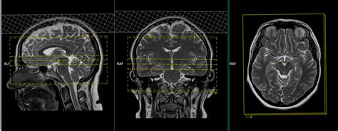 Brain MRA Protocols and Planning | Indications for MRA Brain Scan