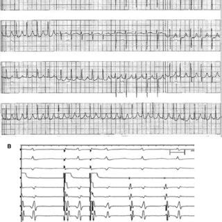 A A 12 Lead Electrocardiogram Revealing Narrow Complex Mid RP