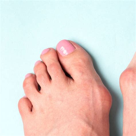 Hallux Valgus Behandeln Und Vorbeugen Compeed