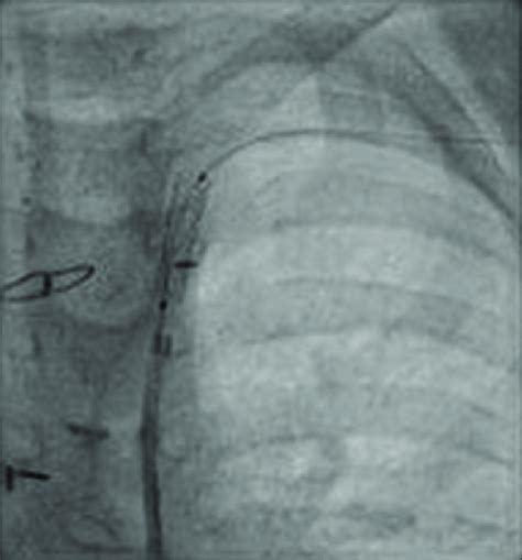 Deployment of stent in left subclavain artery Case 3 | Download ...