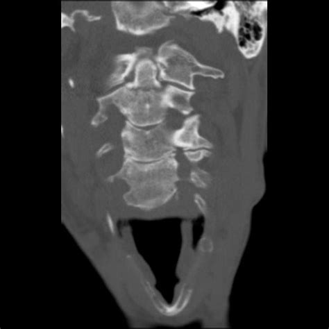 Post Gad: Dens Fracture