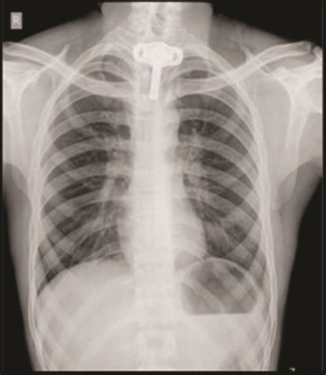 Tracheostomy X Ray