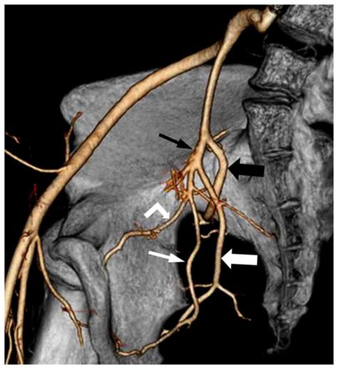 Female Internal Iliac Artery Branches Posterior Division Of The