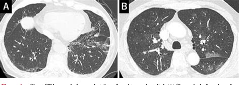 [pdf] Anti Synthetase Syndrome That Relapsed With Pulmonary Arterial Hypertension And Malignancy