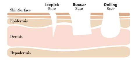 Types of Acne Scars: Pictures, Diagnosis and Treatments