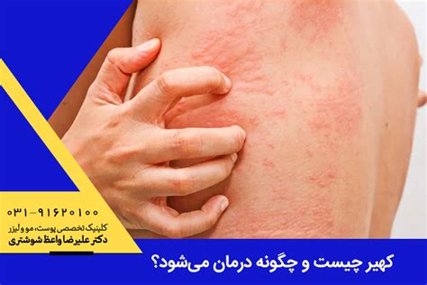 کهیر چیست و علل، علائم و درمان انواع کهیر متخصص پوست در اصفهان