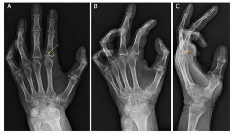 X Rays Of The Left Hand Obtained Day After Hospital Admission A