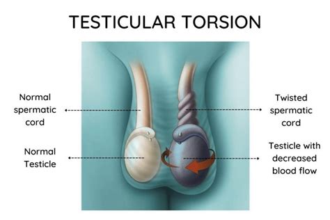 Testicular Torsion Following Inguinal Hernia Surgery A Detailed Study