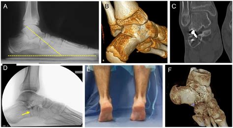 Resection Of Calcaneonavicular And Talocalcaneal Coalitions With